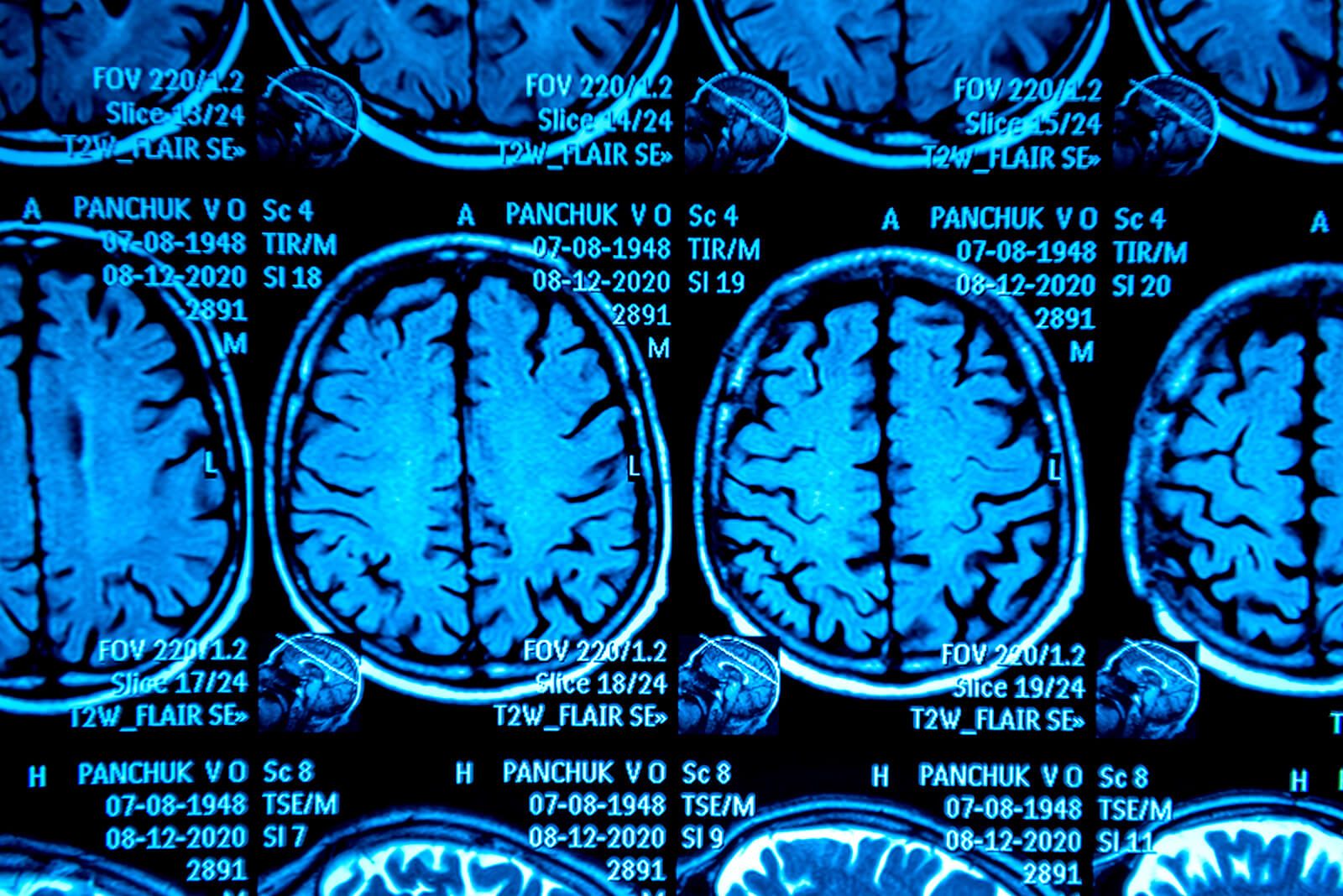 Pseudotumor cerebral