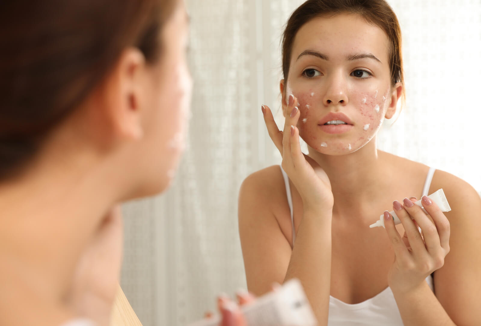 Ragazza cura l'acne premestruale applicando una crema specifica