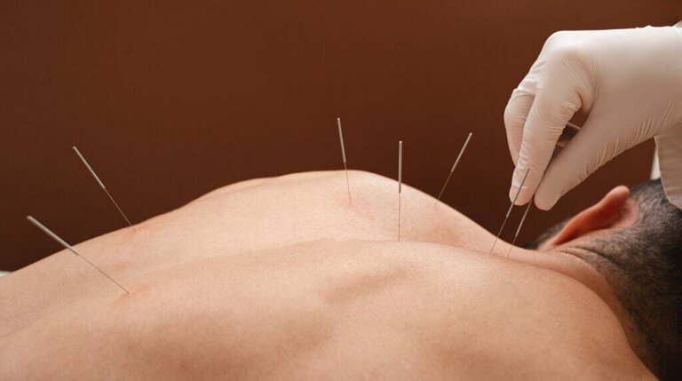 Agopuntura per la fibromialgia: ecco cosa dice la scienza