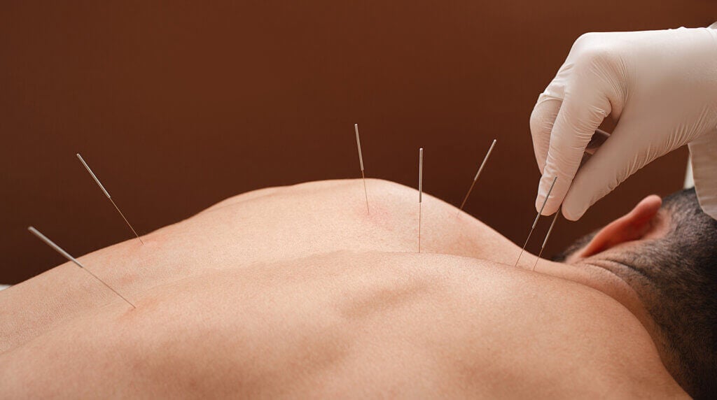 Agopuntura per la fibromialgia: ecco cosa dice la scienza