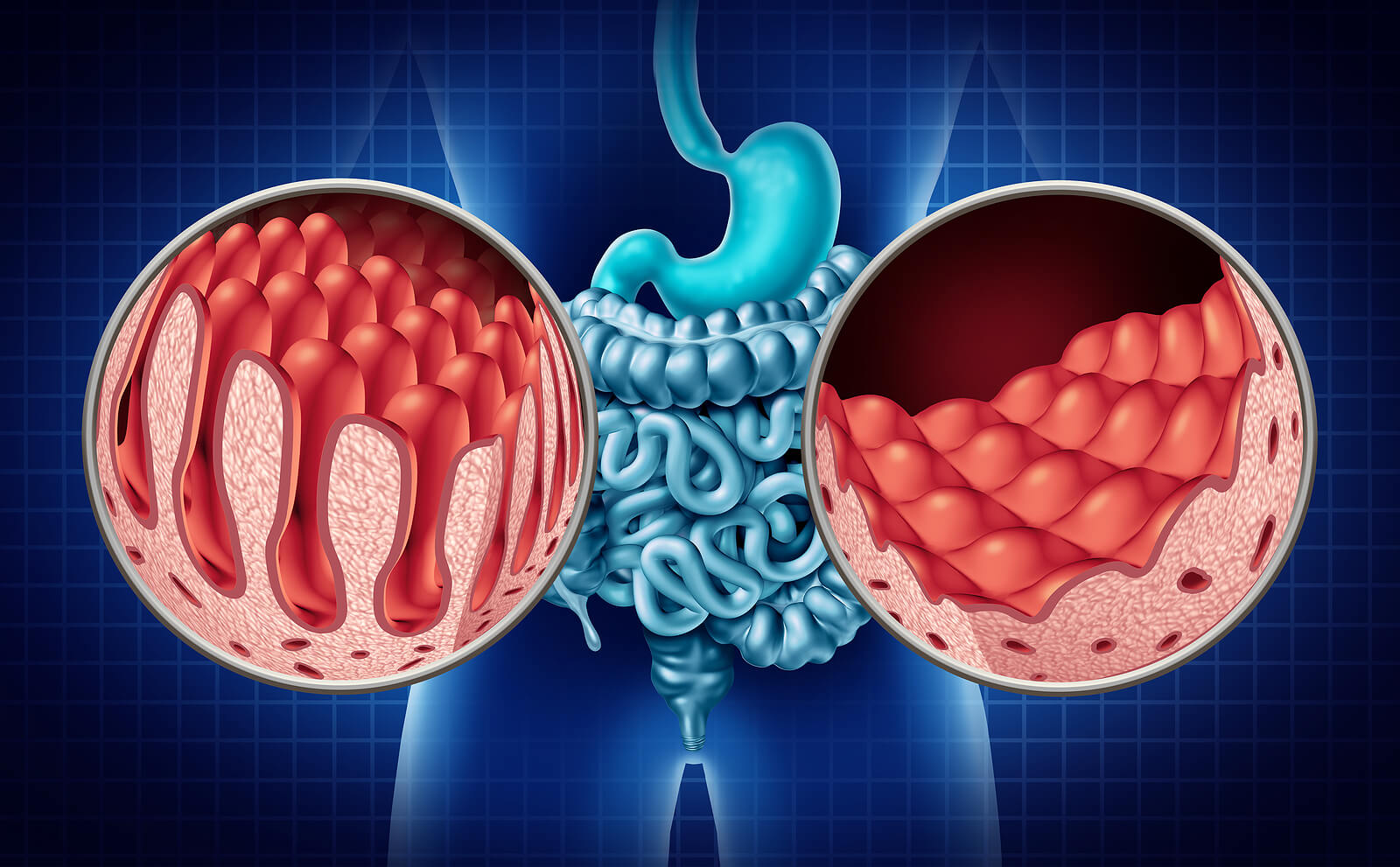 Cosa succede al mio corpo se sono celiaco e assumo glutine?