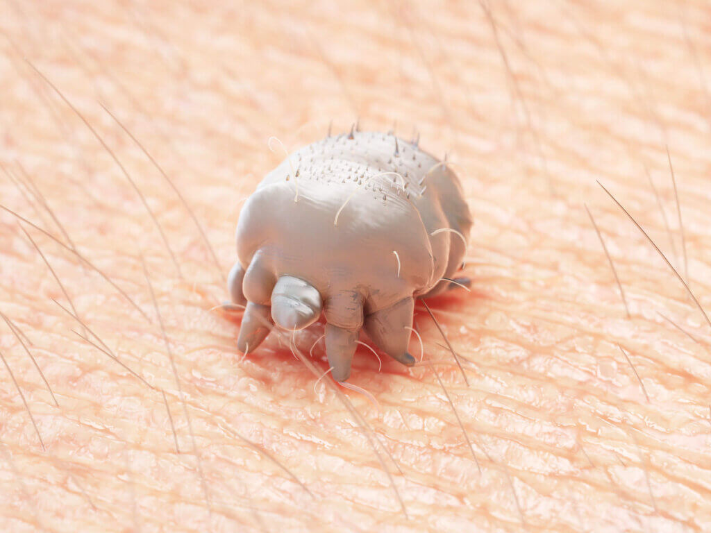 A escabiose ou sarna é uma doença da pele causada pelo ácaro parasita Sarcoptes scabiei.