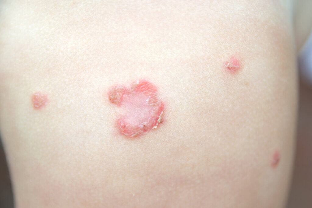 Impetigo: tudo o que você precisa saber