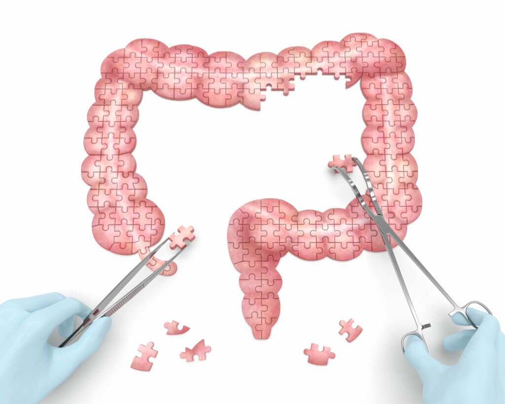 Signos y síntomas de la colitis ulcerosa