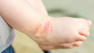Dermatite: facteurs de risque, types et mesures de prévention