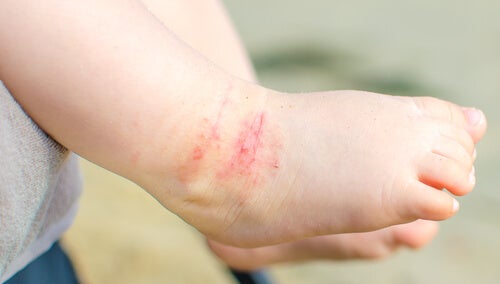 All You Need to Know About Dermatitis