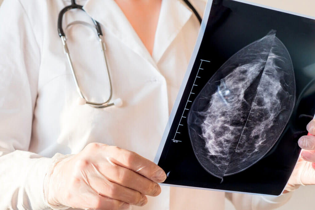 The Prevention of Breast Cancer