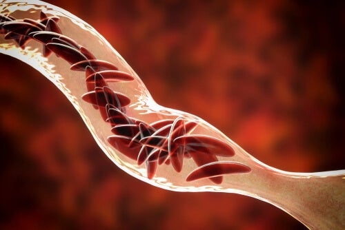 Anémie falciforme: symptômes, diagnostic et traitements