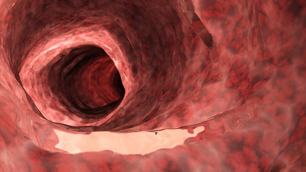 Diferencias entre la colitis ulcerosa y la enfermedad de Crohn