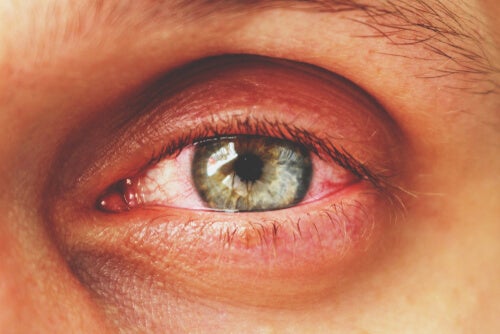 Conjunctivitis: All You Need to Know