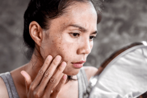 Tipos de manchas en la cara
