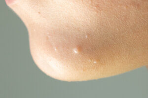 Molusco contagioso: síntomas, causas y tratamiento