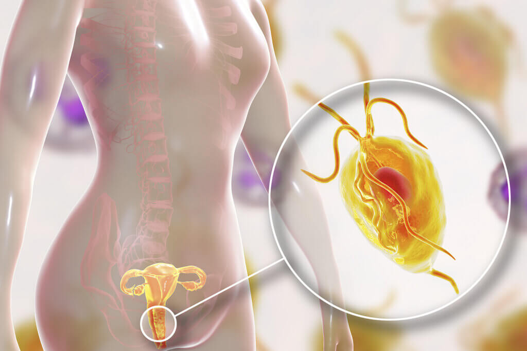 ¿Qué es la tricomoniasis?