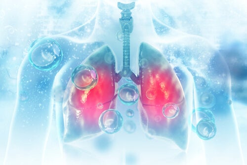 Che cos’è la polmonite?