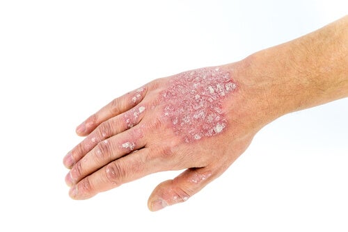 All You Need to Know About Psoriasis