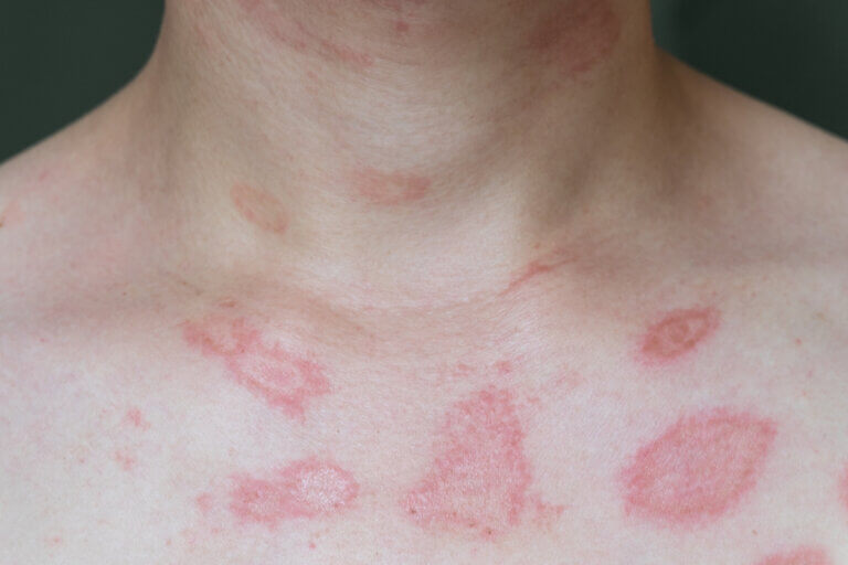 Alergias en la piel: todo lo que debes saber