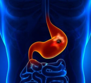 What Are Stomach Ulcers?