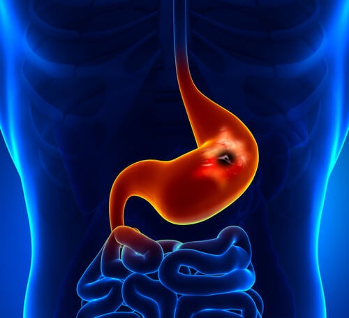 Ulcère gastrique ou de l’estomac: causes, symptômes et traitement