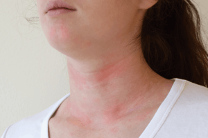 ¿Qué es la urticaria crónica?