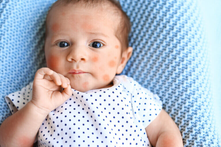 Eccema en bebés: todo lo que debes saber