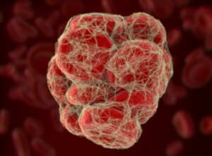 Qu'est-ce que l'embolie pulmonaire?