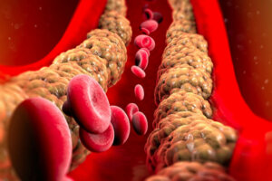 The Different Types of Cholesterol