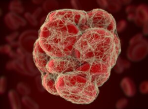 ¿Qué es la embolia pulmonar?