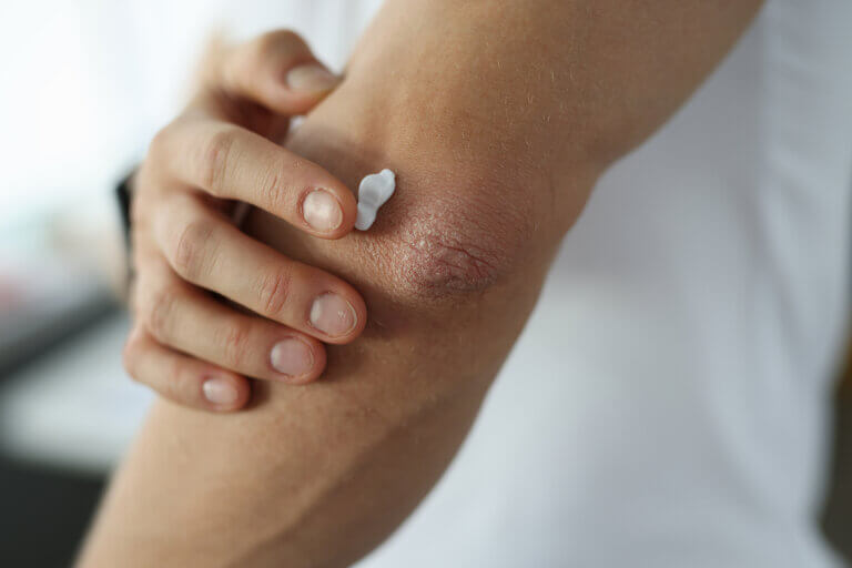Dermatitis En Codos Tratamiento de la dermatitis de contacto - Muy Salud