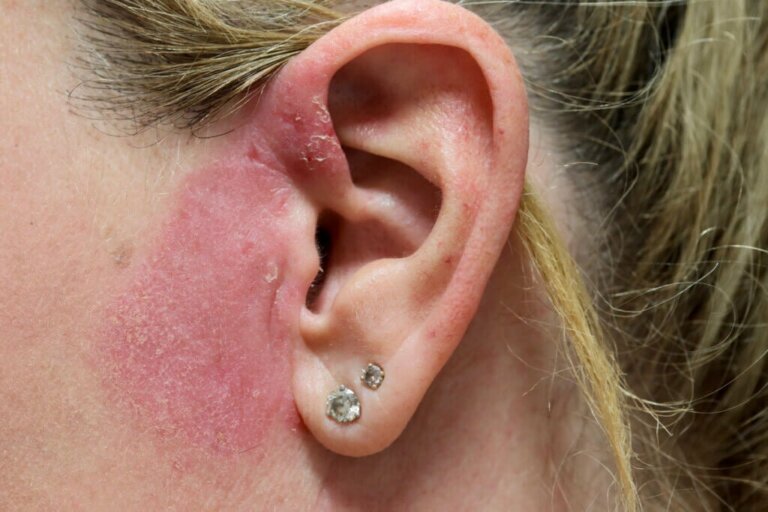 Como a dermatite de contato é diagnosticada?