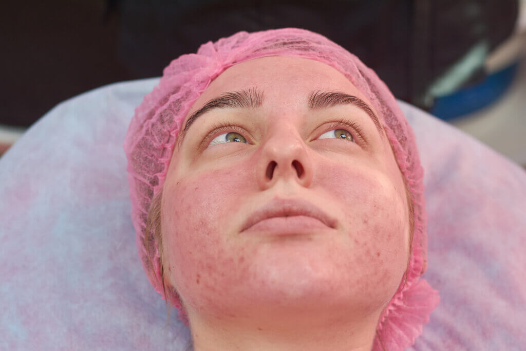 Erythema on the cheeks due to herpes virus.