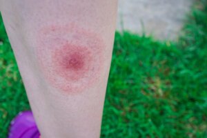 Quels sont les symptômes de la maladie de Lyme?