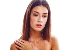 Vitiligo: symptômes, causes et traitement
