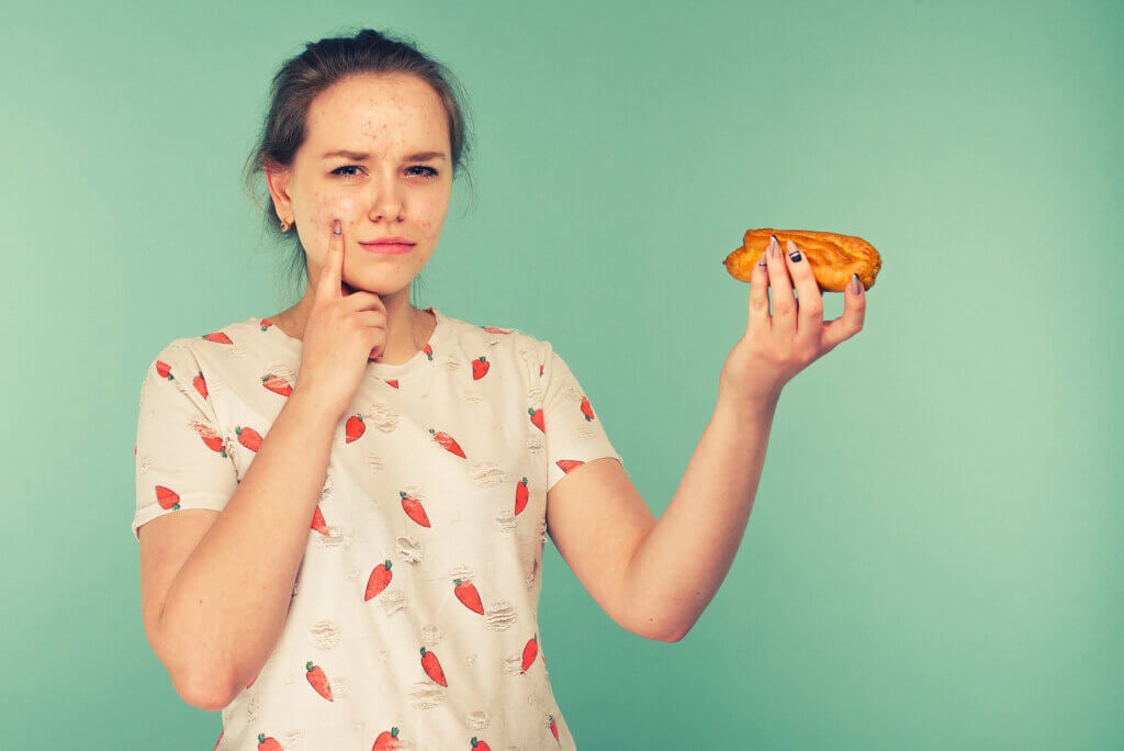 Does Diet Influence Acne?