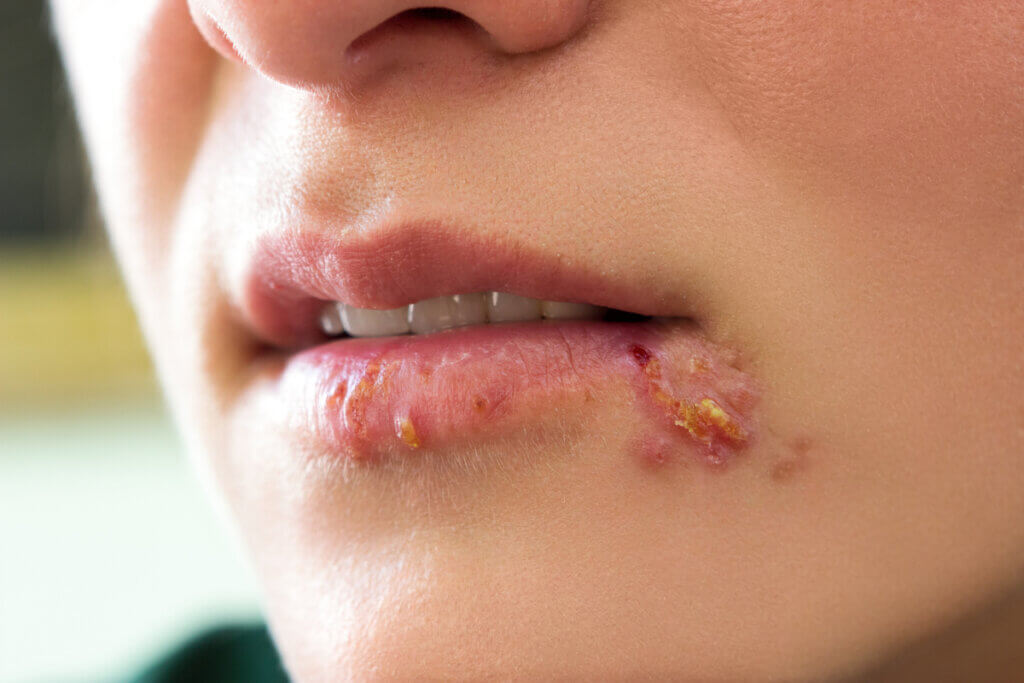 Stress and oral health cause herpes