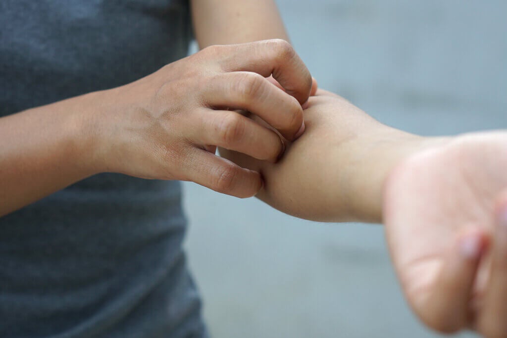What Is Contact Dermatitis?