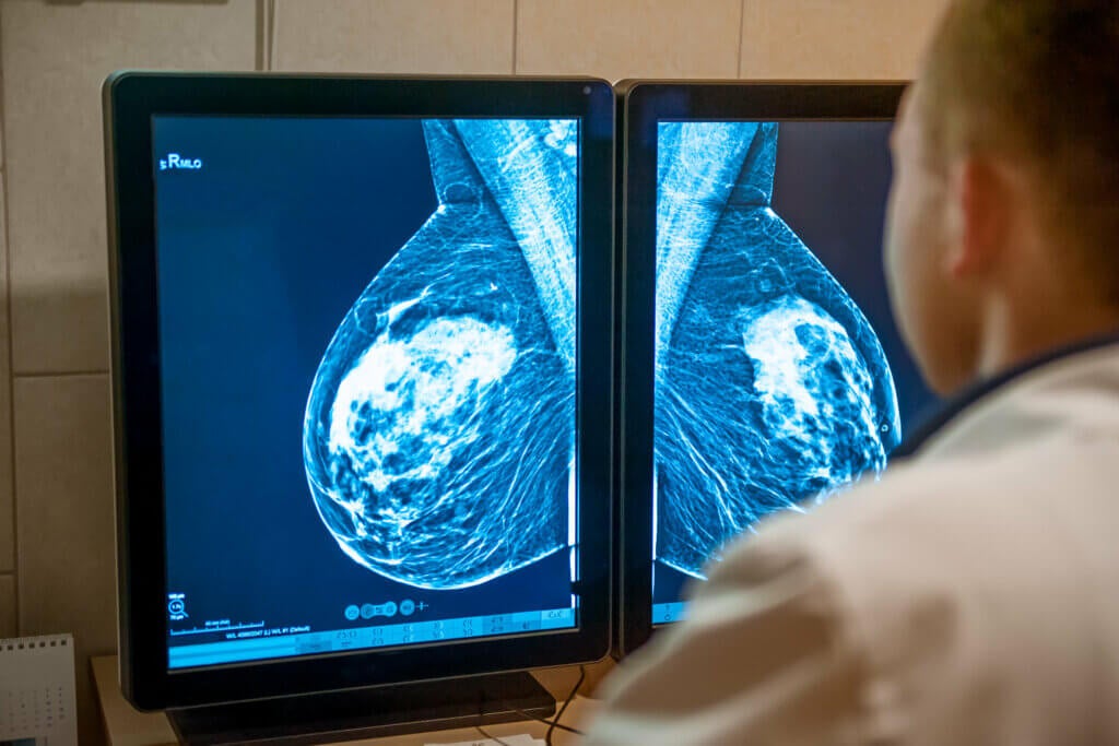 Le fasi del cancro al seno