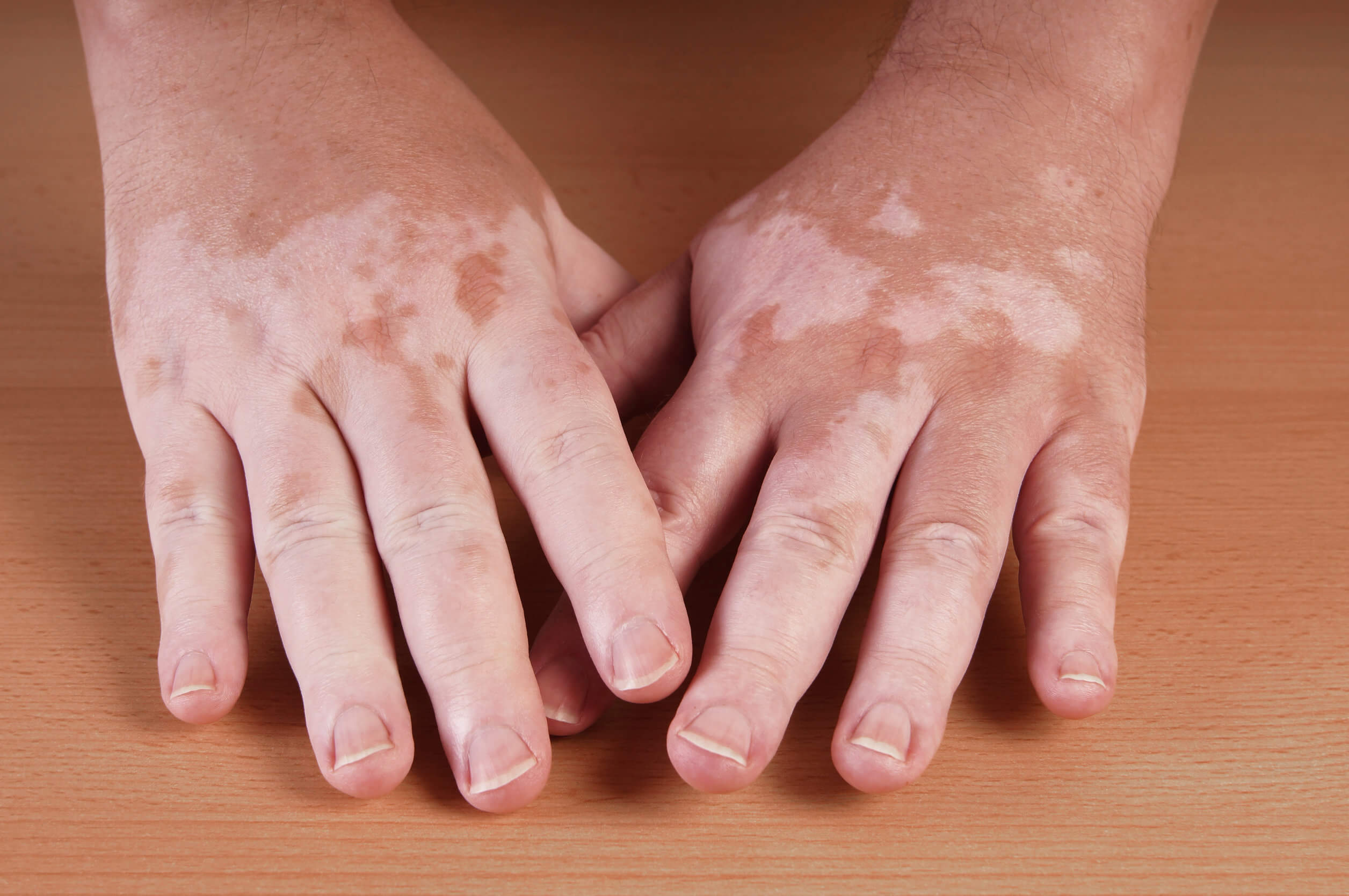 The symptoms of vitiligo are spots