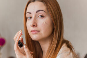 Acné: todo lo que debes saber