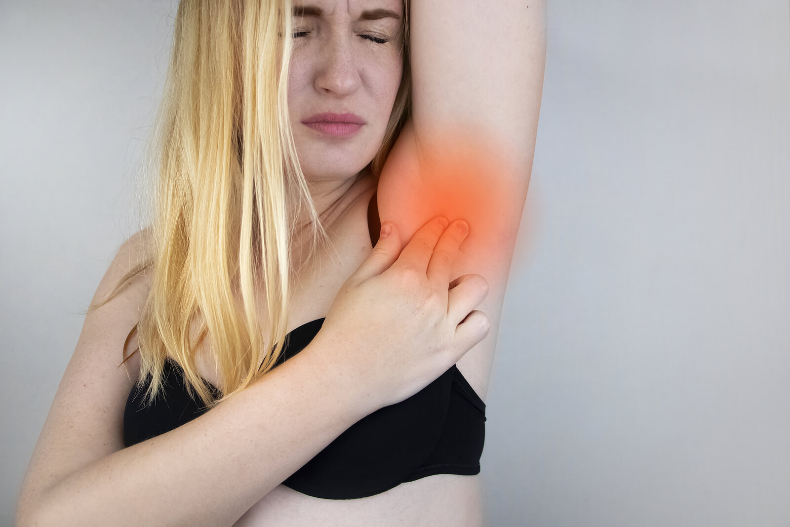 ¿Que es la hidradenitis supurativa?