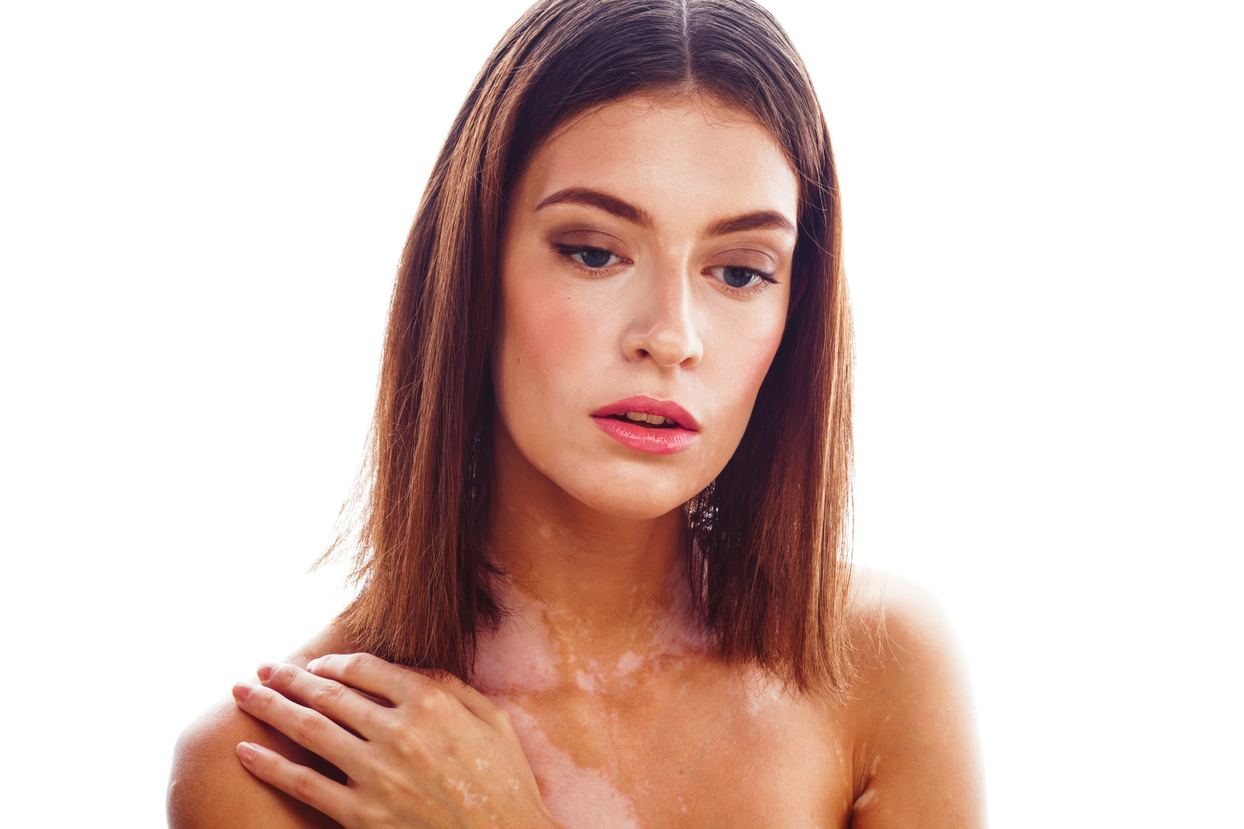 Vitíligo: síntomas, causas y tratamiento