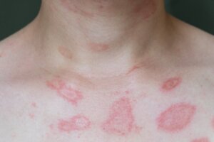 Allergie cutanee: tutto quello che c'è da sapere