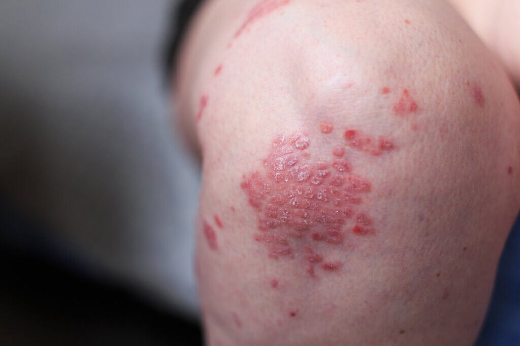 Rhumatisme psoriasique : tout ce que vous devez savoir