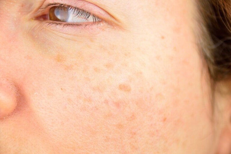 Spots on the Skin: Types, Causes and Treatment