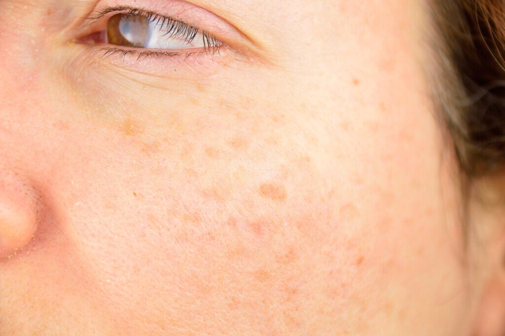 Taches sur la peau: types, causes et traitement