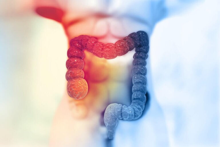 Come prevenire il cancro al colon