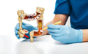 Tipos de cáncer de colon