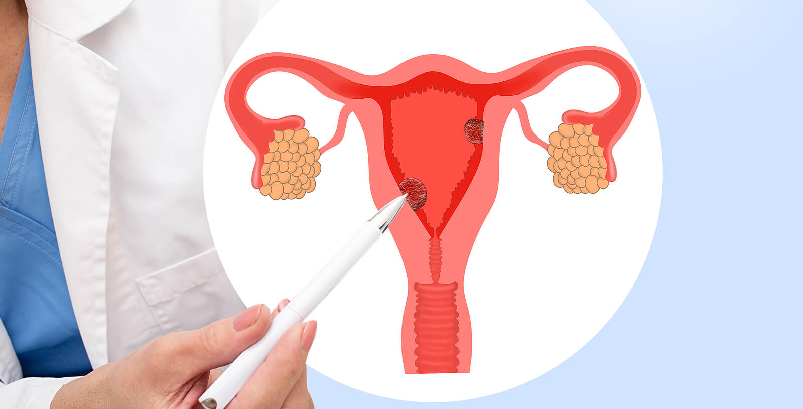 Cáncer de endometrio: síntomas, causas y tratamiento