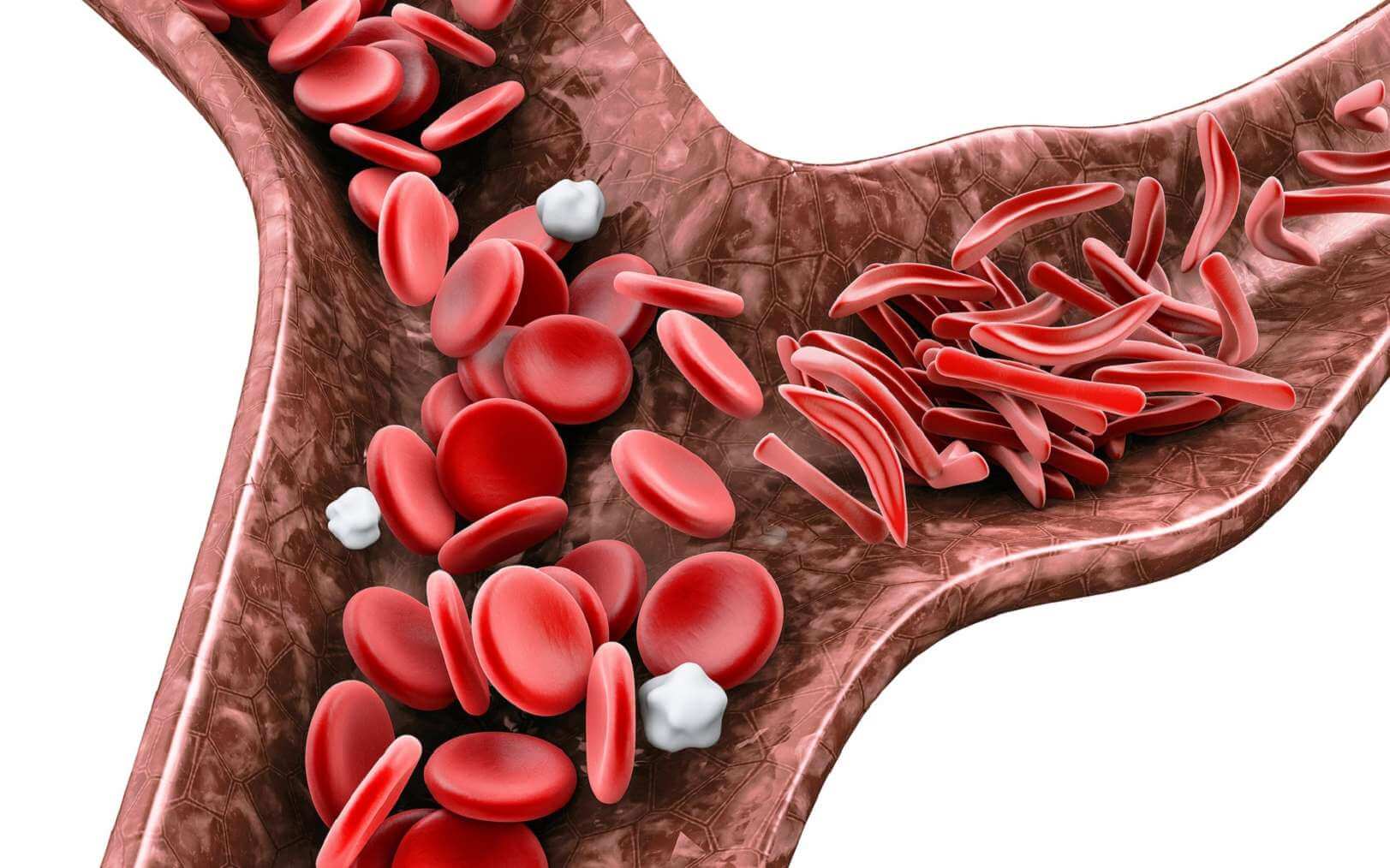 Anémie falciforme symptômes diagnostic et traitements