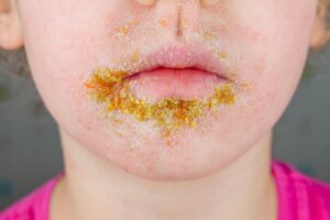 Impetigo: Everything You Need to Know