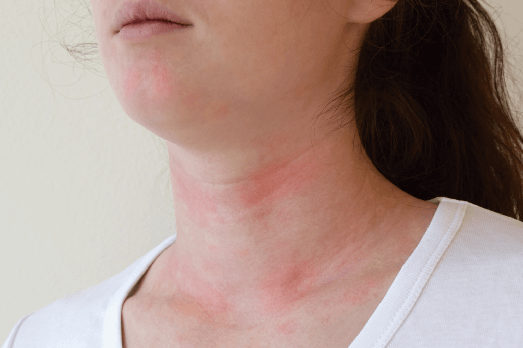 Is Chronic Urticaria Dangerous